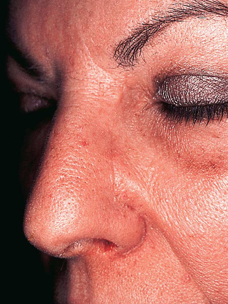 Figure 6.74, Postoperative appearance of the patient 8 weeks following surgery.