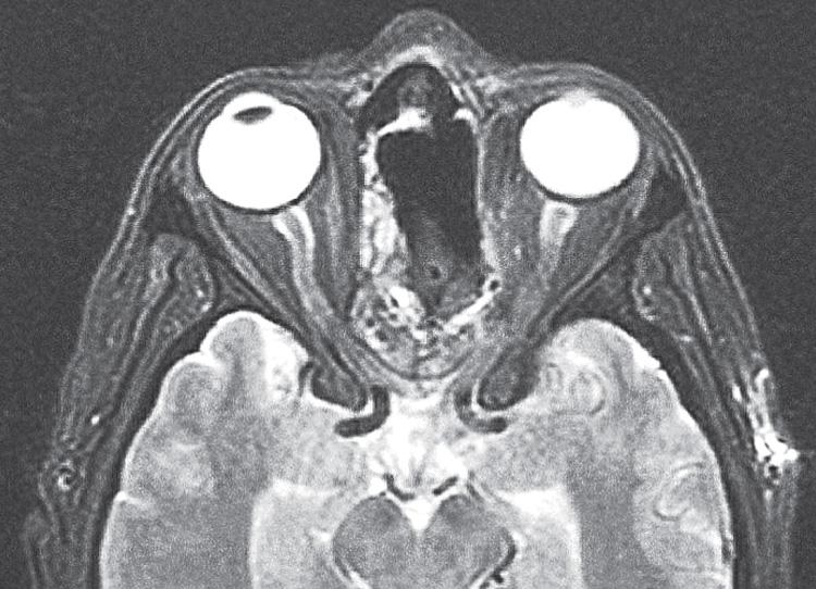 Figure 6.75, An axial view of the postoperative magnetic resonance imaging scan.