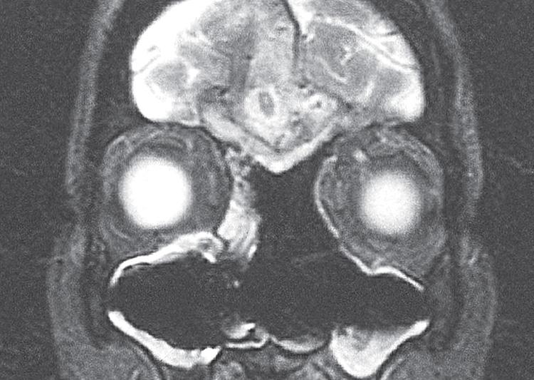 Figure 6.76, A coronal view of the postoperative magnetic resonance imaging scan.