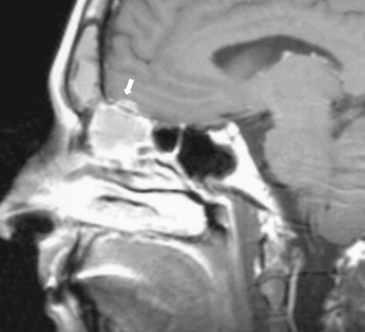 Figure 6.12, A sagittal postcontrast T1-weighted magnetic resonance imaging scan showing dural enhancement ( white arrow ) from invasion by an esthesioneuroblastoma.