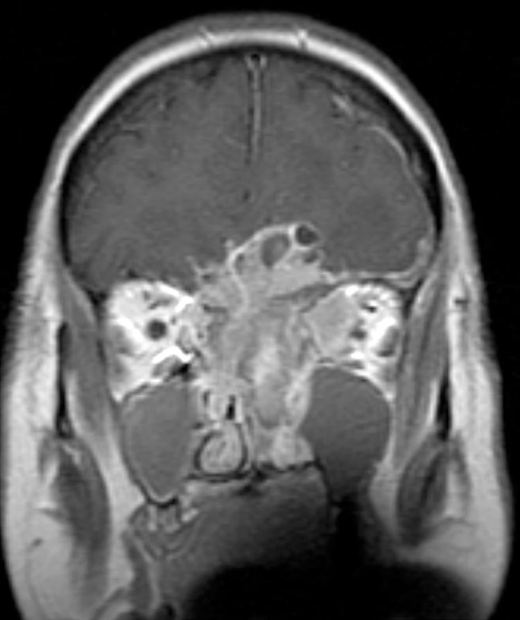 Figure 6.13, Peripheral cysts around an area of brain parenchymal invasion in a patient with an esthesioneuroblastoma.