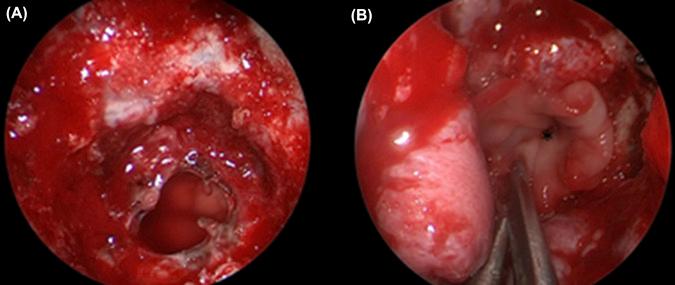 Figure 22.1, (A) Endoscopic endonasal view of a posterior fossa defect following a transclival resection of a large chordoma breaching the dura. (B) DuraGen placed in subdural inlay and onlay fashion.