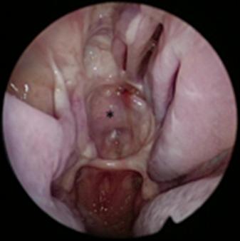 Figure 22.2, Endoscopic endonasal view of a nasoseptal flap ( NSF) (denoted by ∗) 5 months following endoscopic endonasal resection of a right chondrosarcoma. The endoscopic view is through the right nostril. The two nasal cavities are connected after a partial septectomy. A NSF reconstructs the skull base defect and a reverse NSF covers the remaining caudal cartilaginous septum left in place to support the nasal tip.