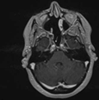 Figure 22.3, A 6 months postoperative axial MRI T1 with contrast following endoscopic endonasal transclival resection of right chordoma with reconstruction showing the nasoseptal flap well vascularized and adherent to the brainstem and carotid arteries with no dead spaces.