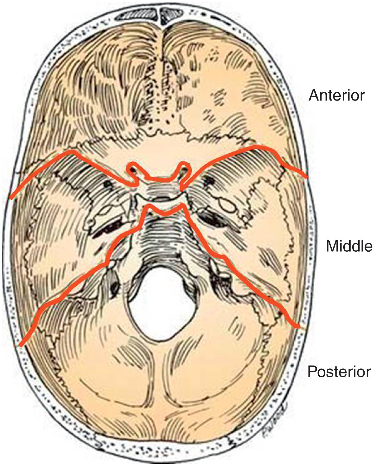 Fig. 20.1, Axial section of the skull base. Dark lines separate the three skull base compartments: anterior, middle and posterior.