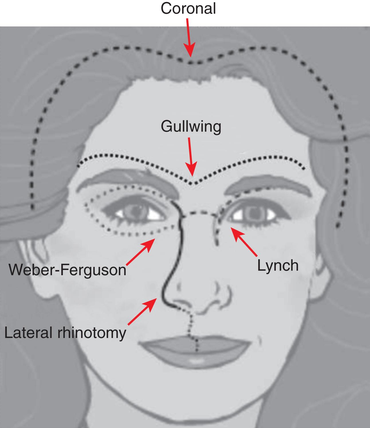 Fig. 20.2, Image depicting various external incisions that allow access to the skull base.