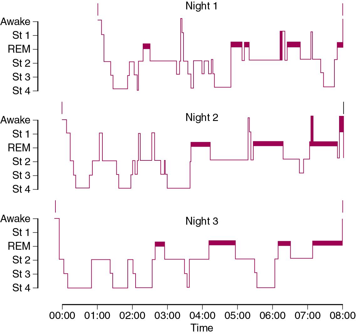 • Fig. 14.1, Patterns of sleep on three consecutive nights in a 20-year-old fit man. The thick horizontal bars indicate rapid eye movement (REM) sleep.