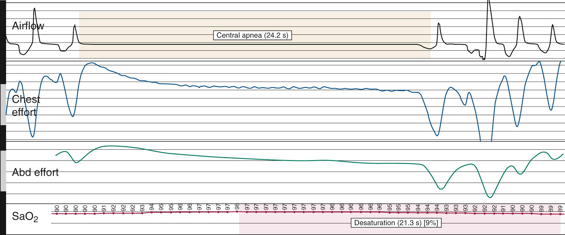 Fig. 15.11, Polysomnographic tracing of a central apnea.