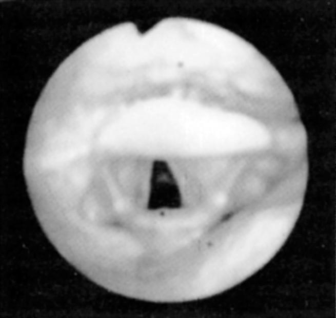 Fig. 15.3, Fiberoptic view of the normal hypopharyngeal airway.