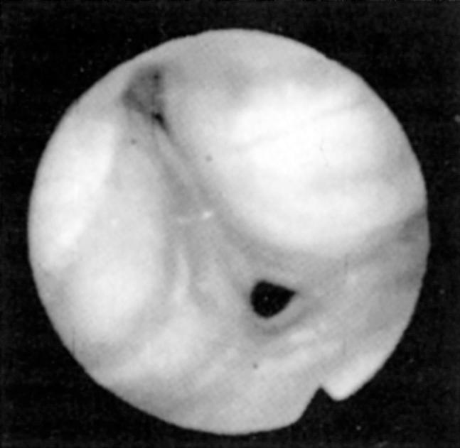 Fig. 15.6, Fiberoptic view of hypopharyngeal collapse during the Müller maneuver.