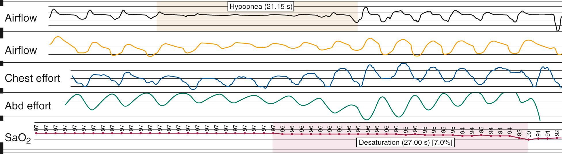 Fig. 15.10, Polysomnographic tracing of a hypopnea.