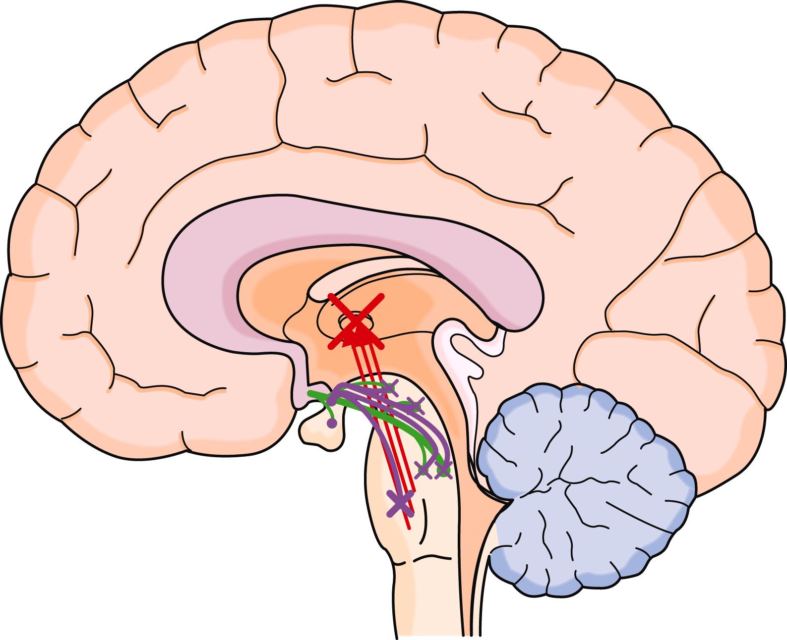 E-FIGURE 374-2, Activation of the ventral lateral preoptic nucleus subsequently inhibits ( purple arrows ) the reticular activating system ( red ) and the monoaminergic nuclei ( green ), thereby producing non–rapid eye movement sleep and blocking sensory input to the hemispheres.