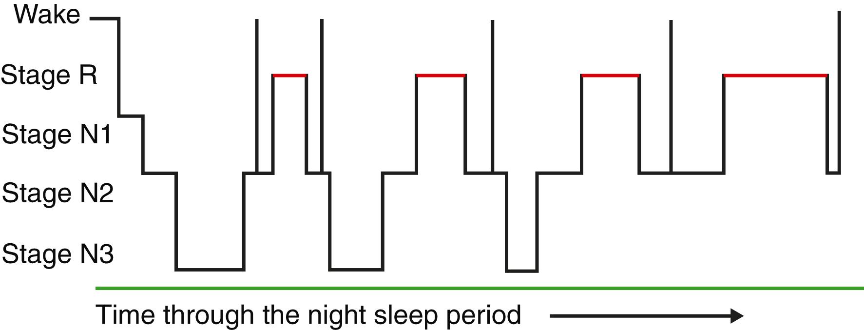 FIGURE 374-1, Hypnogram showing sleep stages across a sleep period.