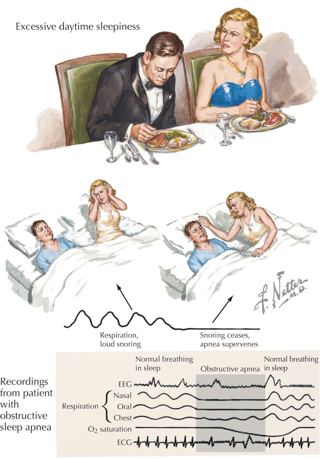 FIG 71.1, Obstructive Sleep Apnea.