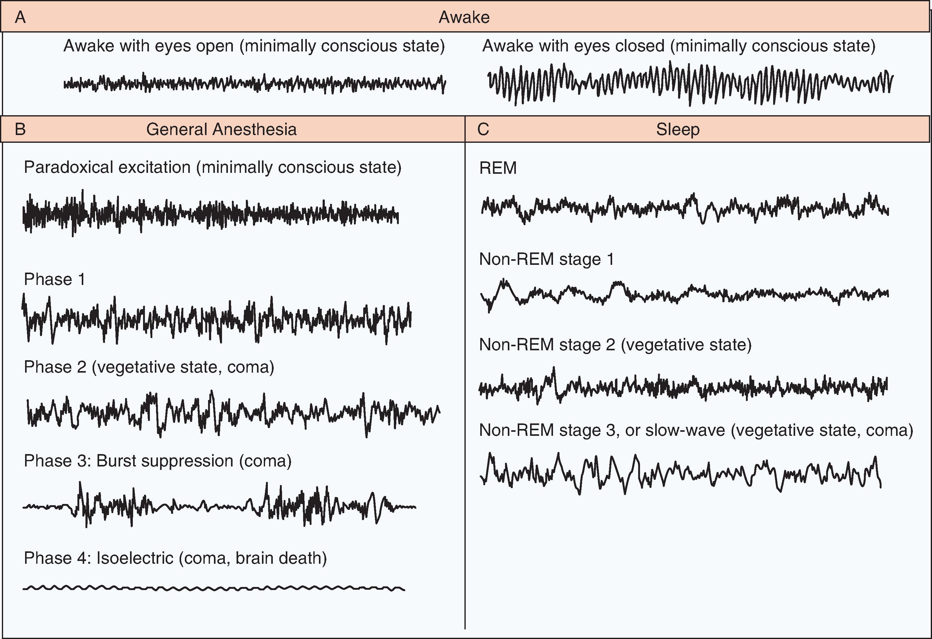 Fig. 48.1, Electroencephalographic patterns during awake state, general anesthesia, and sleep.