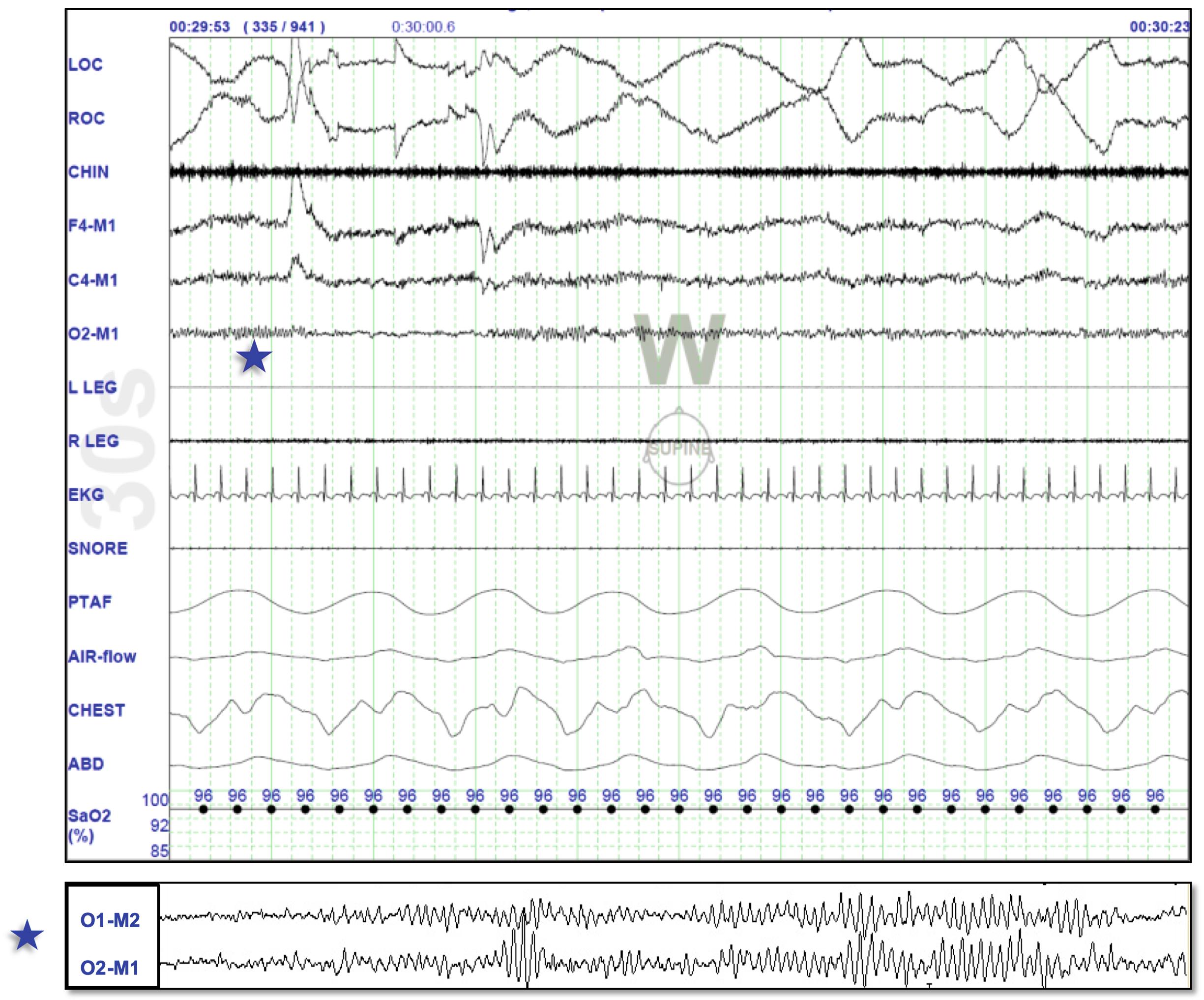 Fig. 101.2, Polysomnographic Recording Depicting Wakefulness in an Adult.