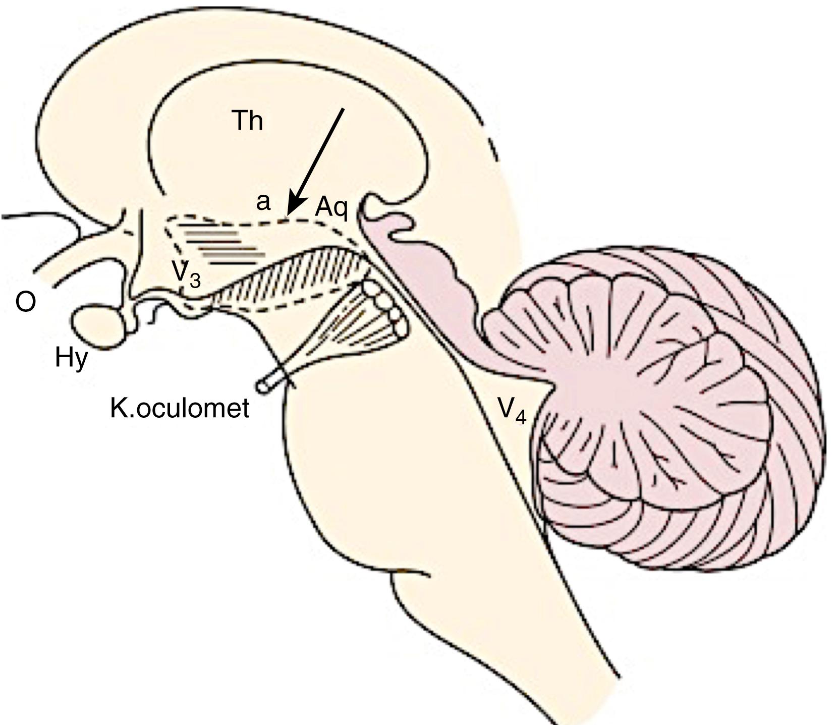 eFig. 101.27, The Origin of Encephalitis Lethargica or Von Economo’s Sleeping Sickness.