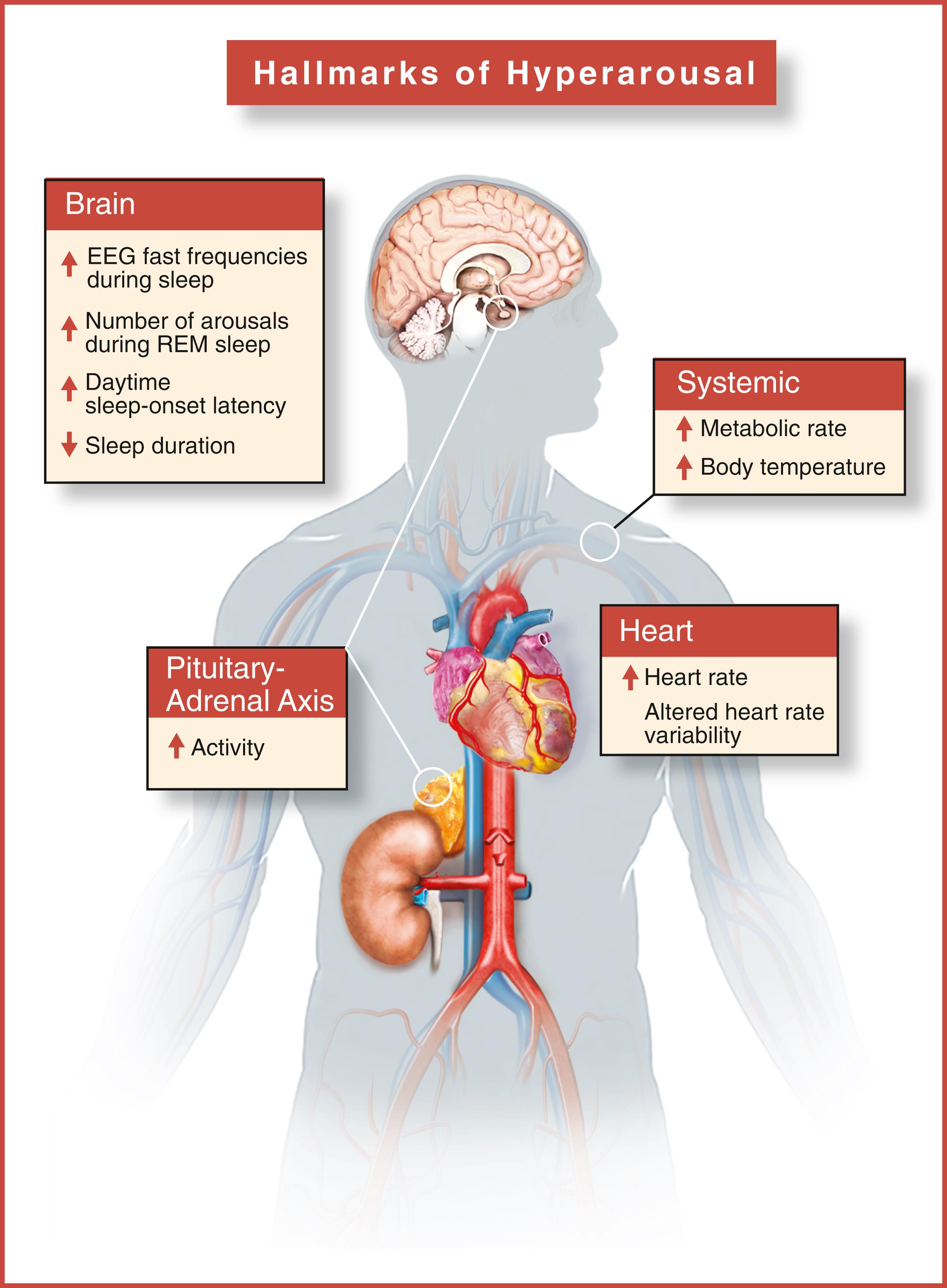 Fig 101.30, Indicators of Hyperarousal in Insomnia.