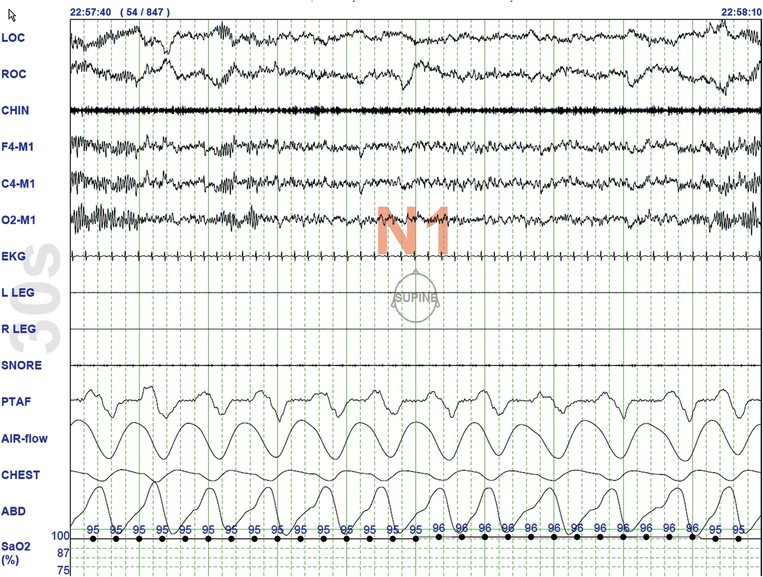 Fig. 101.3, Polysomnographic Recording Shows Stage 1 Nonrapid Eye Movement (NREM) Sleep (N1) in an Adult.