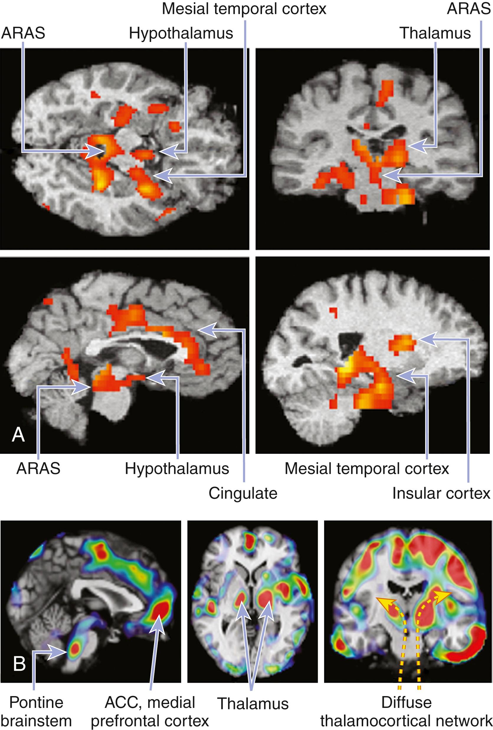 eFig. 101.32, Neuroimaging in the Setting of Insomnia Disorders.