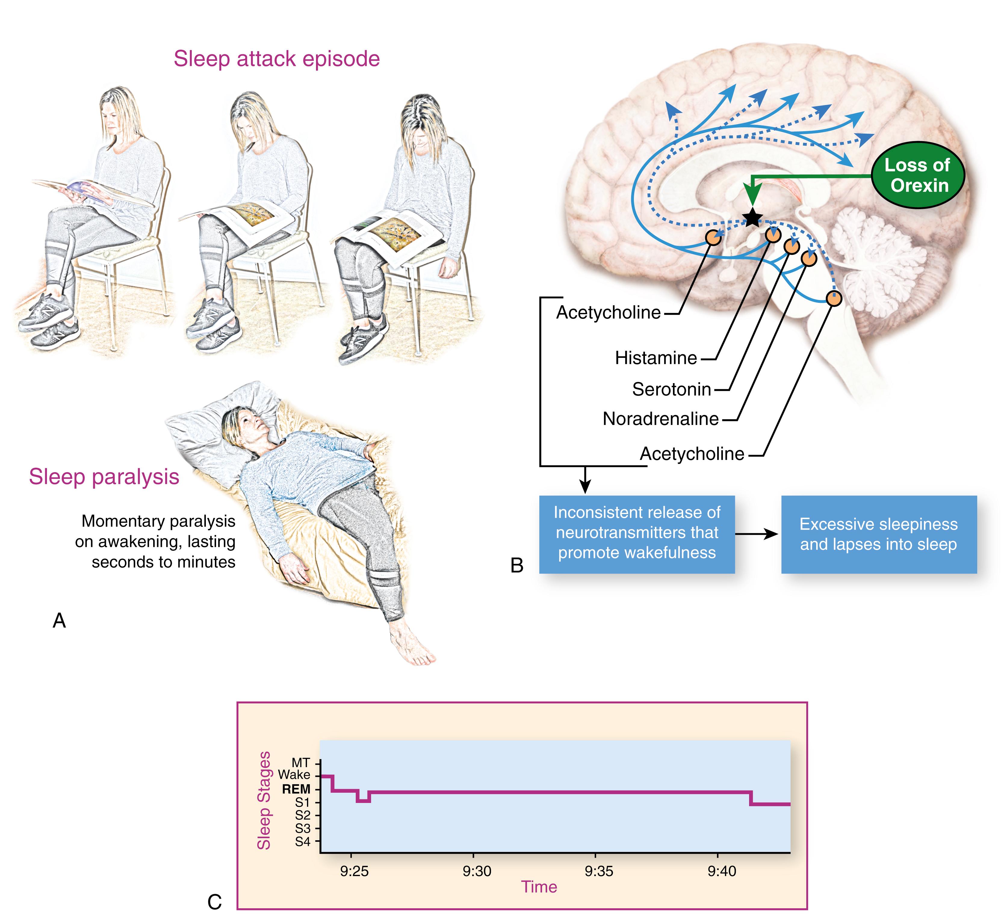 Fig. 101.38, Narcolepsy Symptom Spectrum.