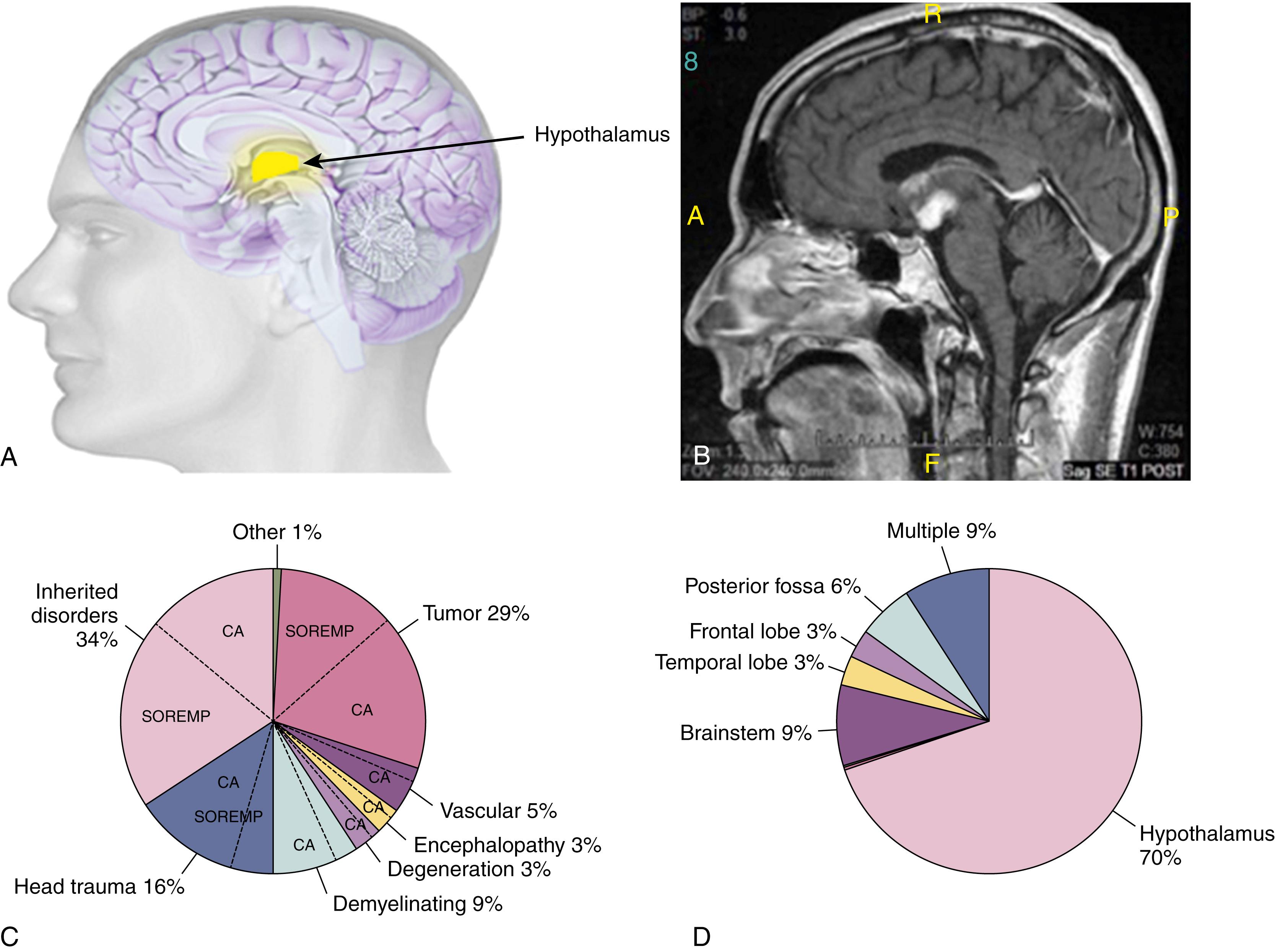 Fig. 101.41, Secondary or “Symptomatic” Narcolepsy.