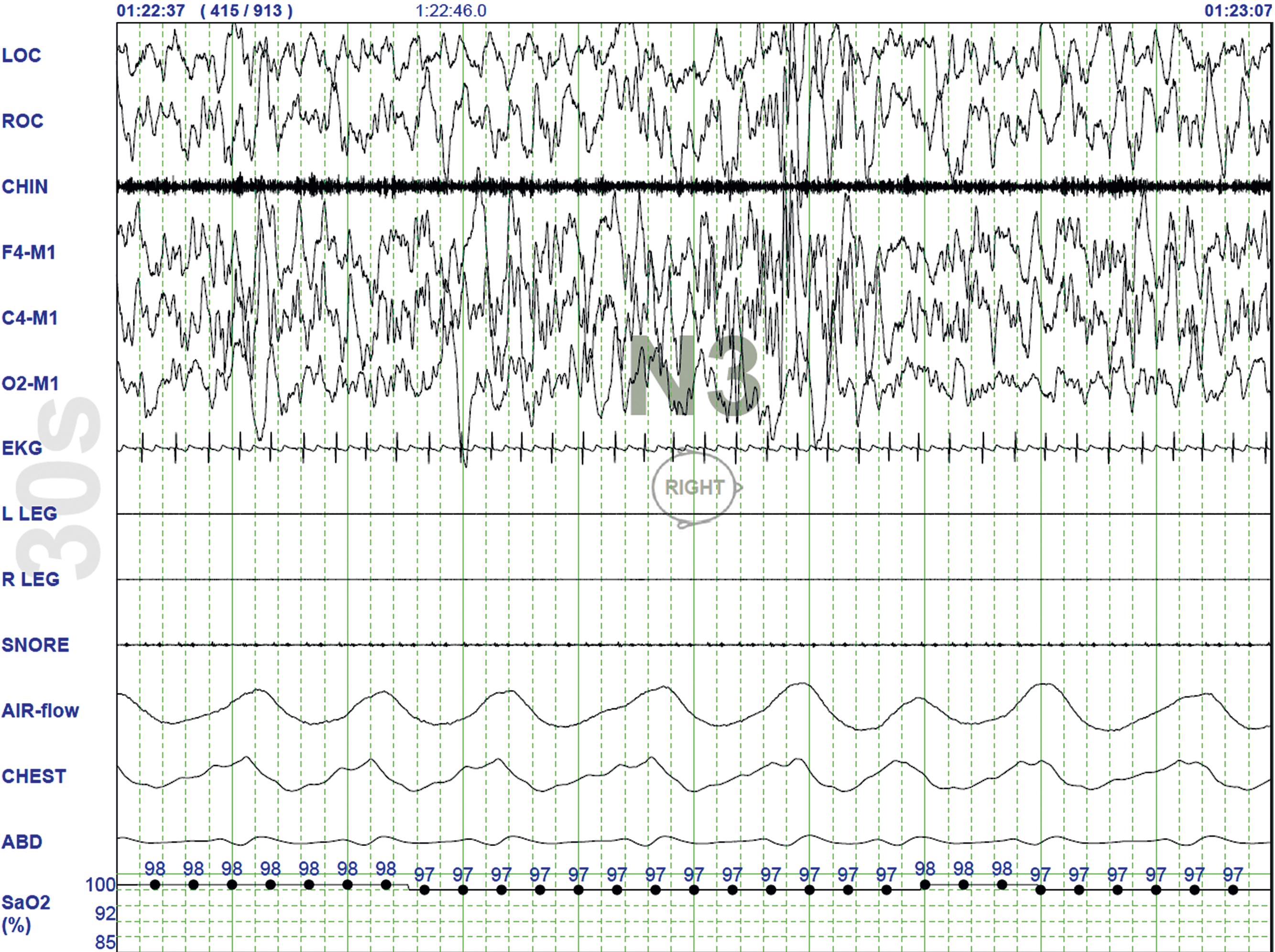 Fig. 101.5, Stage N3 Sleep.