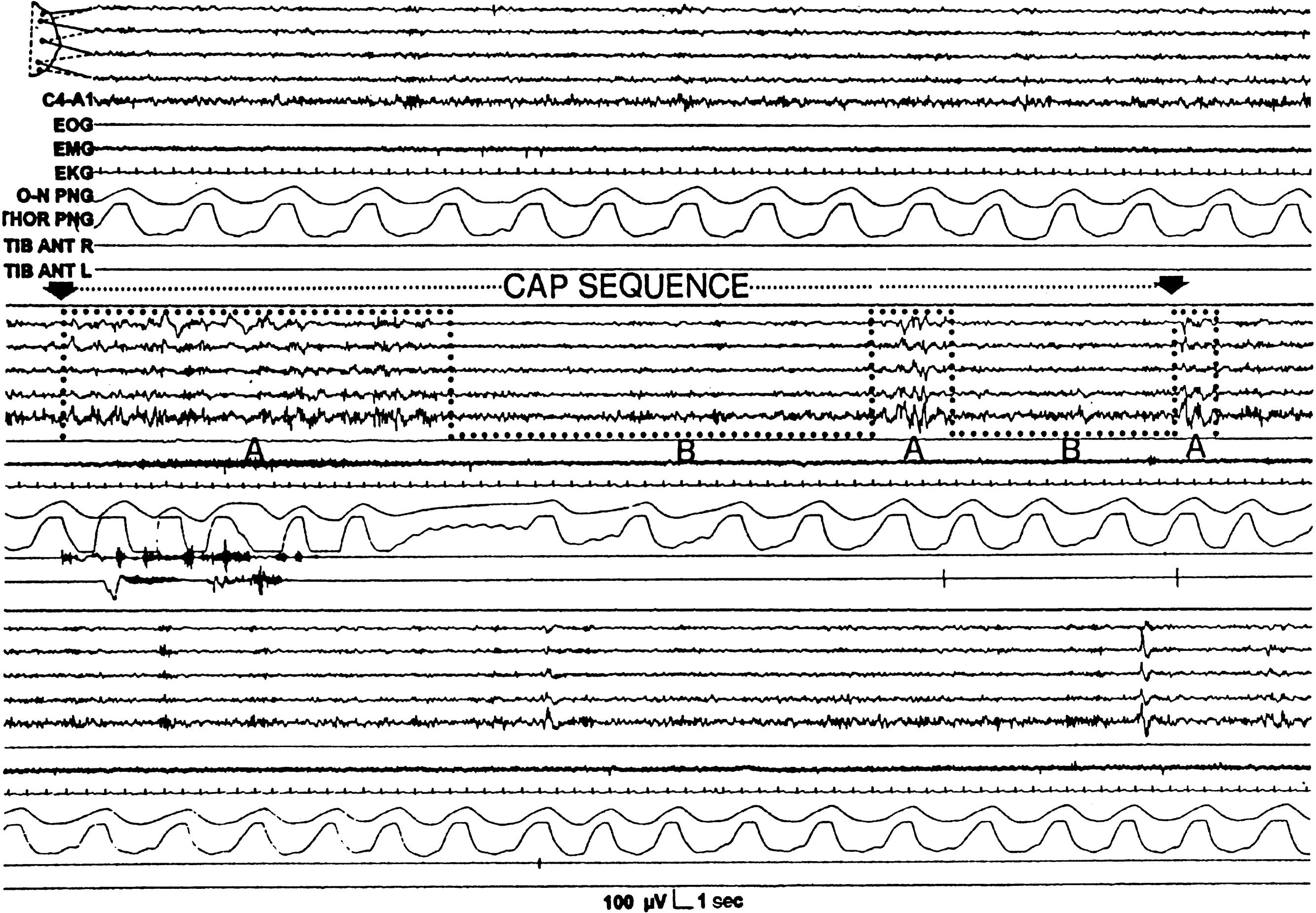 eFig. 101.8, Cyclic Alternating Pattern in Human Sleep.