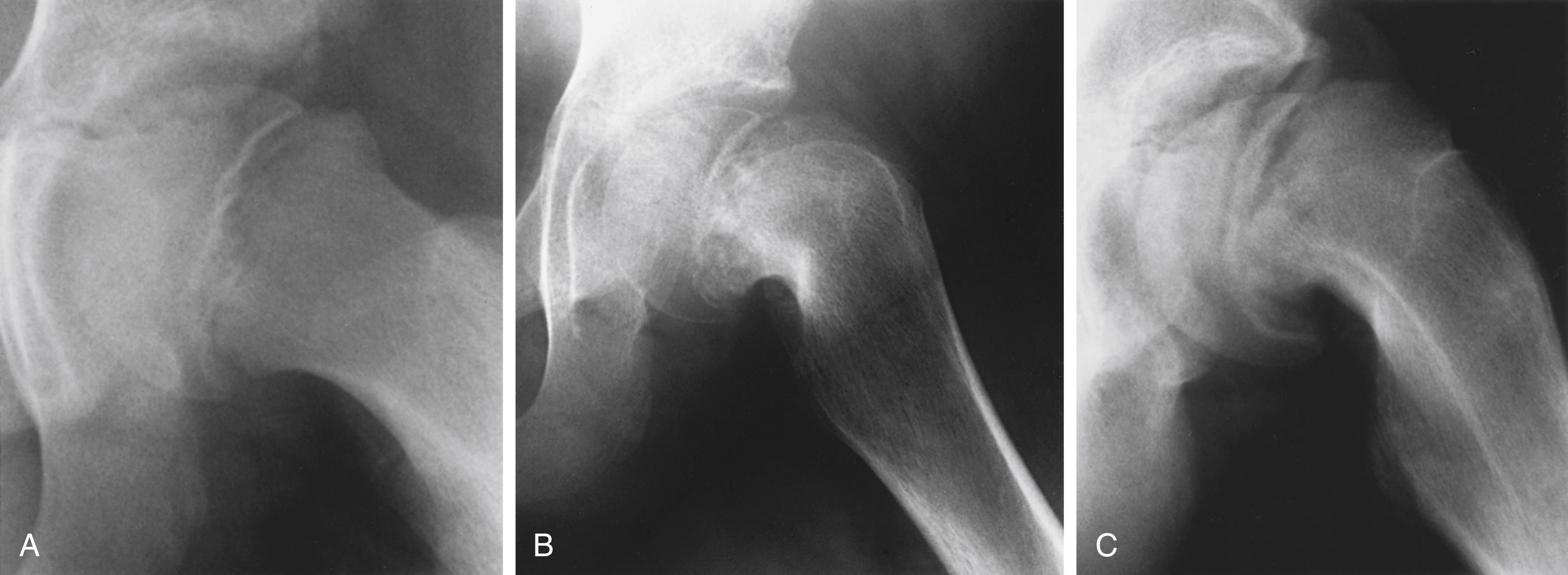 FIG. 15.1, Radiographic appearance of slipped capital femoral epiphysis (SCFE) on presentation. (A) Appearance of acute SCFE on a frog-leg lateral view. The displacement of the epiphysis is suggestive of a Salter-Harris type I fracture of the upper femoral physis. There are no secondary adaptive changes noted in the femoral neck. (B) Frog-leg lateral radiographs in a patient with many months of thigh discomfort and a chronic slipped epiphysis. Adaptive changes in the femoral neck predominate, and the epiphysis is centered on the adapted femoral neck. (C) Frog-leg lateral radiographs of a patient with acute-on-chronic SCFE. The patient had several months of vague thigh pain, with sudden, severe exacerbation of that pain. The acute displacement of the epiphysis is evident. Unlike in acute SCFE (see A), secondary adaptive remodeling changes are also present in the femoral neck, beyond which the epiphysis has acutely displaced.