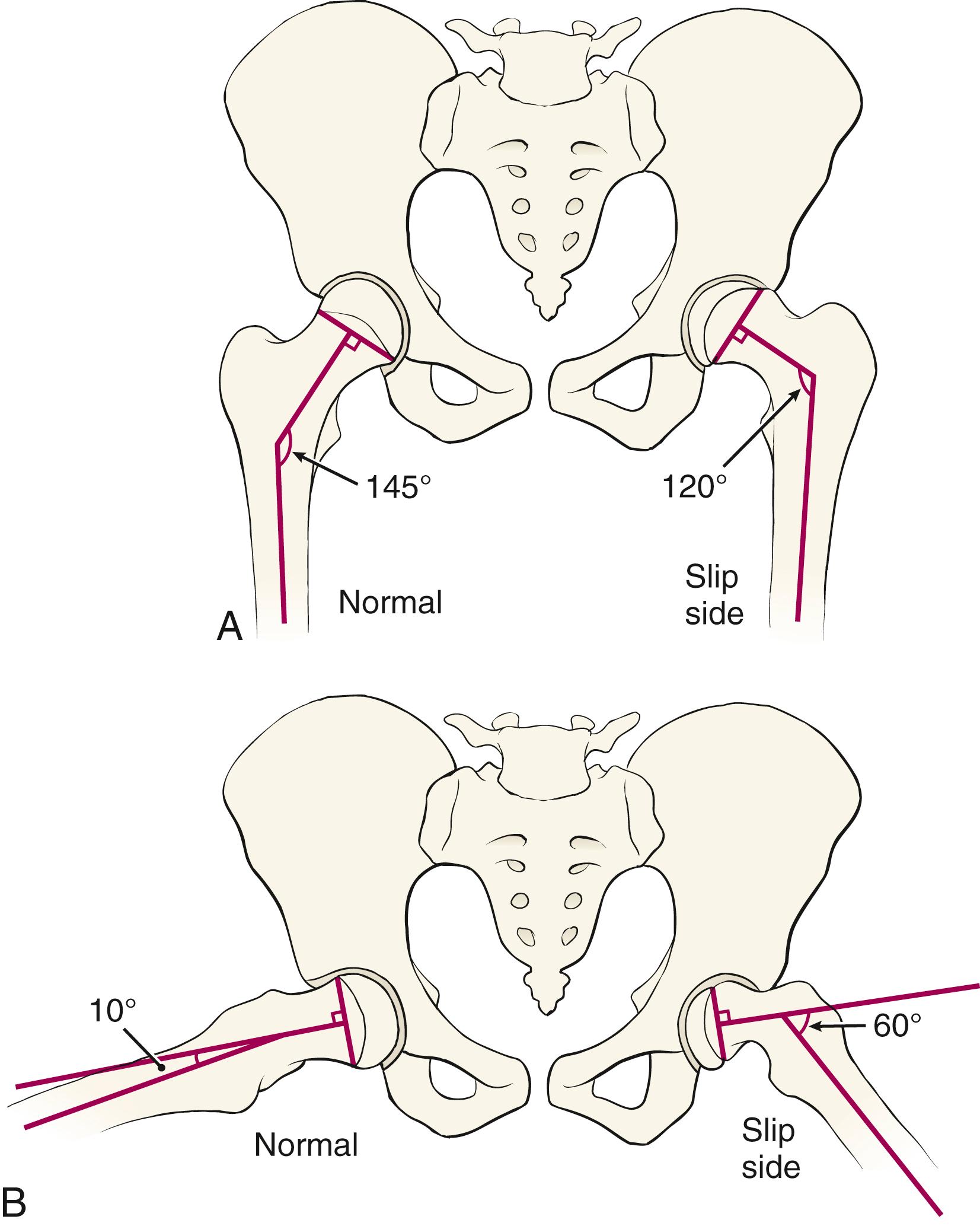 FIG. 15.2, Southwick method of measuring the head-shaft angle to assess the severity of slipped capital femoral epiphysis. (A) Lines are drawn corresponding to the axis of the femoral shaft and the base of the capital femoral epiphysis. The head-shaft angle is the angle between the axis of the femoral shaft and is perpendicular to the base of the epiphysis. Normally this angle is 145 degrees. (B) Similar lines may be drawn on the frog-leg lateral radiographs. Mild slips have less than 30 degrees of displacement, moderate slips have 30 to 60 degrees of displacement, and severe slips have more than 60 degrees of displacement compared with the contralateral normal side.