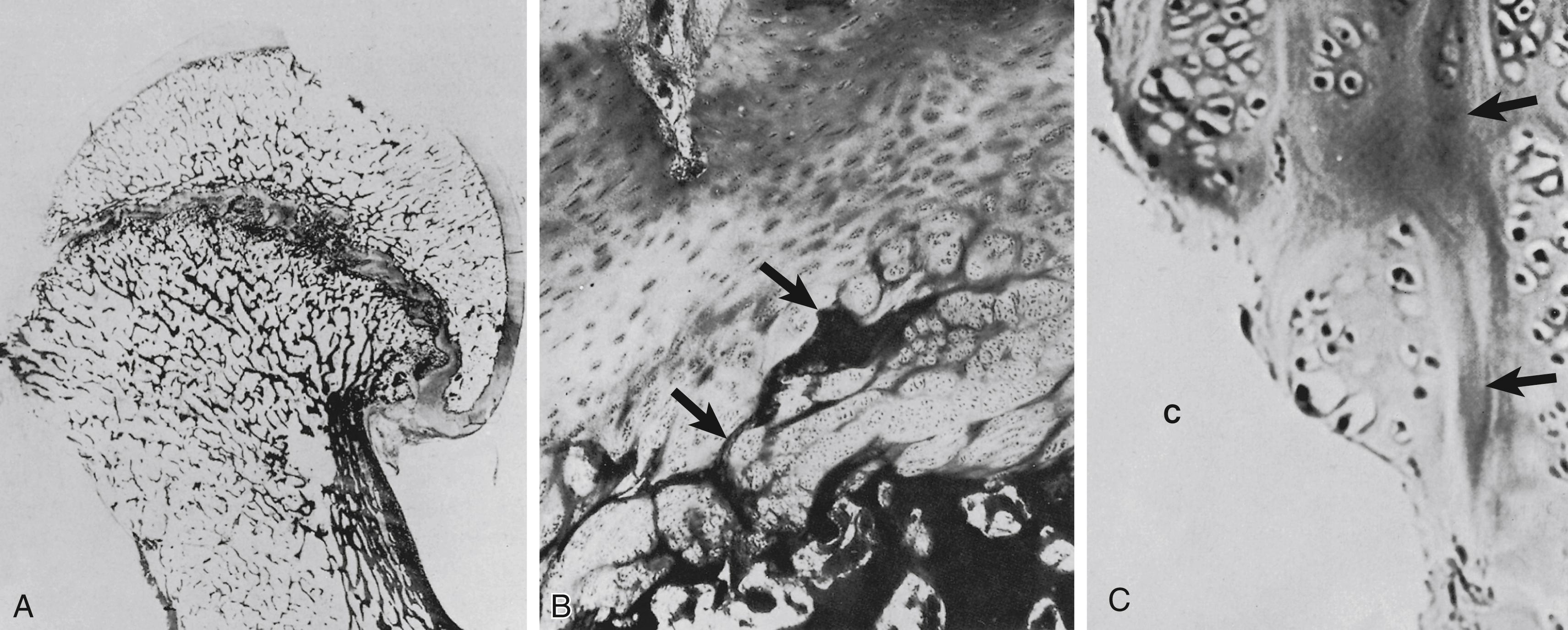 FIG. 15.4, Slipped capital femoral epiphysis: photomicrographs of a specimen. (A) The entire specimen (femoral head and neck). Slipping has occurred through the hypertrophied zone of the physis (hematoxylin-eosin, original magnification ×2). (B) A portion of the growth plate (hematoxylin-eosin, original magnification ×50). The zone of hypertrophy is widened and composed of chondrocytes in disarrayed clusters instead of orderly columns. Dark-staining eosinophilic bands (arrows) separate the cartilage clusters. (C) Higher magnification of the growth plate. The chondrocytes of the hypertrophied zone at the cleft (C) region are in disordered clusters and irregular columns. The cartilage cell masses are separated by dark-staining eosinophilic septa ( arrows ; hematoxylin-eosin, original magnification ×200).