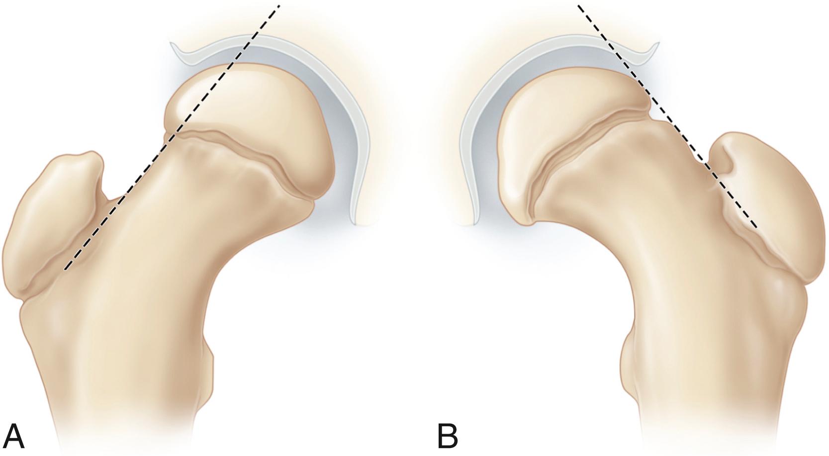 FIG. 15.6, Anteroposterior radiographic appearance of a normal hip and a hip with mild chronic slipped capital femoral epiphysis. (A) Normal hip. A line drawn parallel to the superior femoral neck (Klein line) will intersect the lateral-most portion of the capital femoral epiphysis. (B) Hip with mild chronic slip. Klein line does not intersect the capital epiphysis (Trethowan sign). Lateral radiographs will confirm the diagnosis.