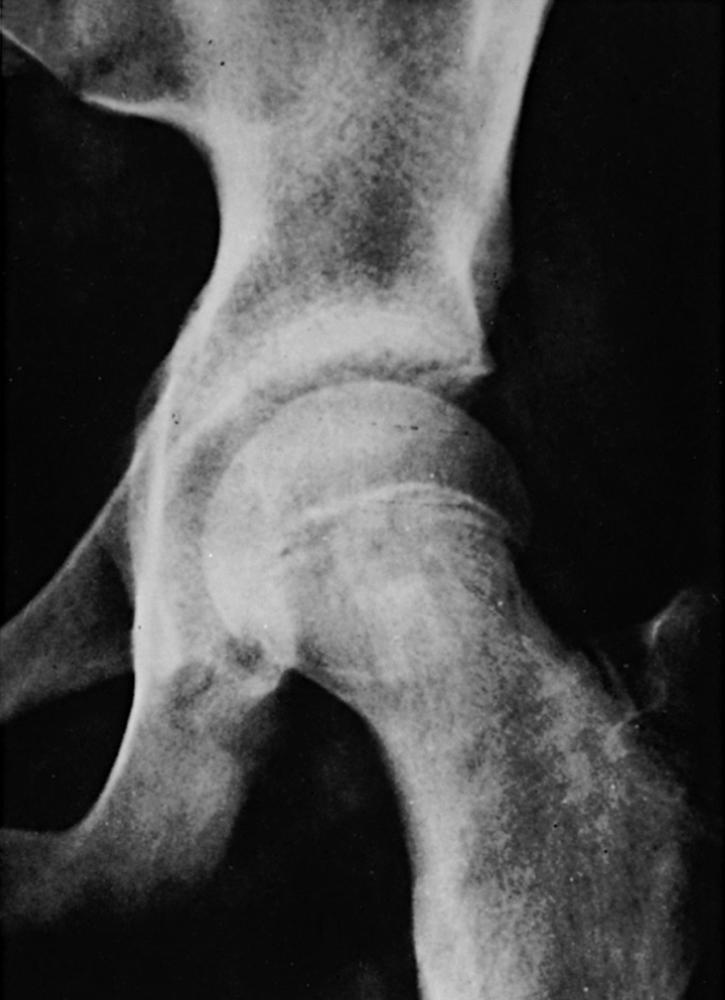 FIG. 15.7, Metaphyseal blanch sign of Steel in slipped capital femoral epiphysis. A crescent-shaped area of increased density lies over the metaphysis of the femoral neck adjacent to the physis. This density is produced by overlapping of the femoral neck and the posteriorly displaced capital epiphysis on the anteroposterior view of the hip.