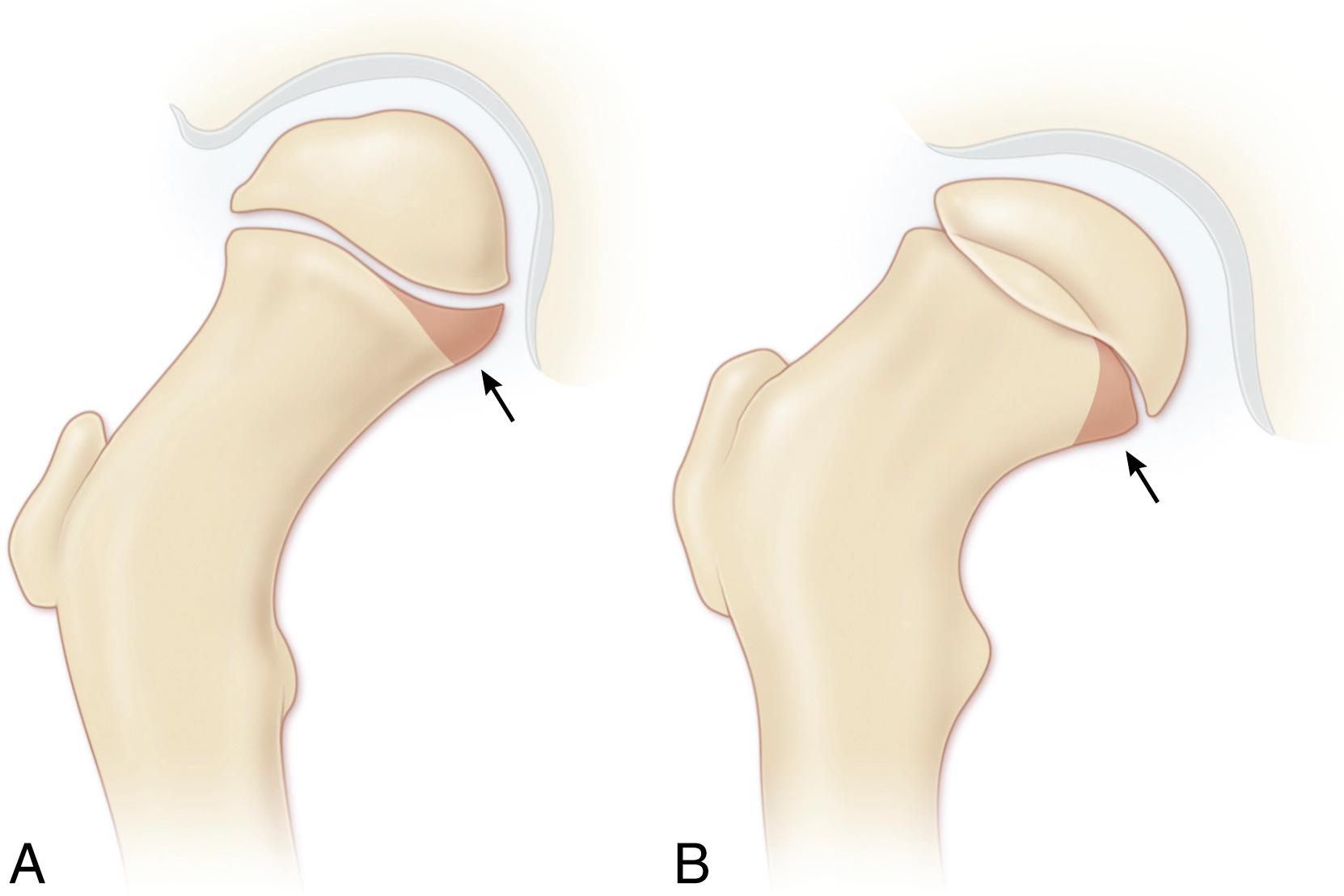 FIG. 15.8, Scham sign of slipped capital femoral epiphysis. (A) In the normal hip, the inferomedial femoral neck overlaps the posterior wall of the acetabulum, producing a triangular radiographic density on the anteroposterior view. (B) With displacement of the capital epiphysis, this dense triangle is lost because this portion of the femoral neck is located lateral to the acetabulum.
