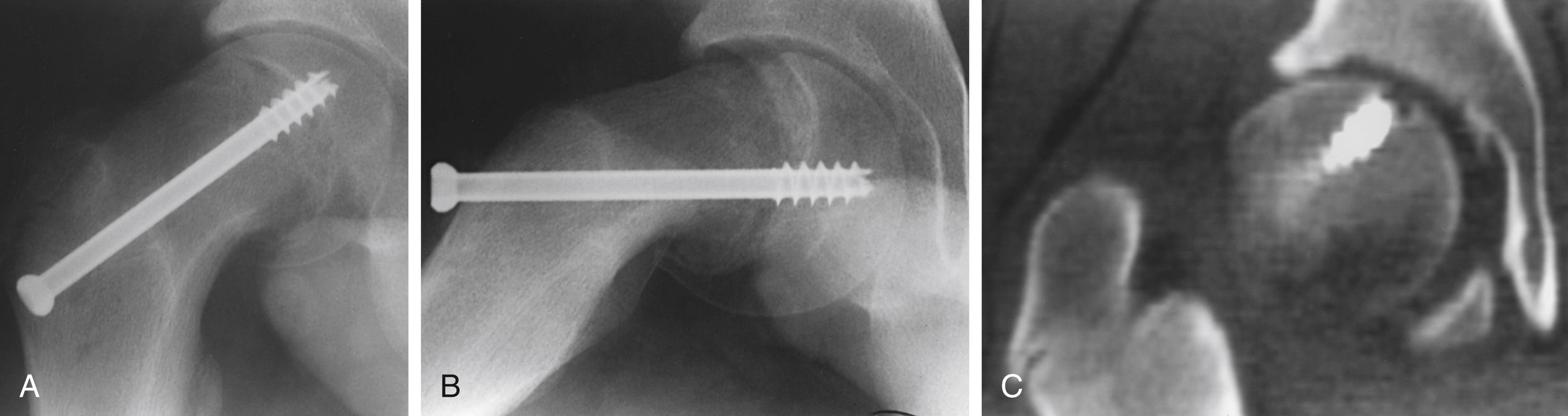 FIG. 15.9, Computed tomography (CT) evaluation of implant penetration into the femoral head. Plain radiographs show no early evidence of chondrolysis or penetration of the hip joint by the screw on anteroposterior (A) or frog-leg lateral (B) projections. CT scan (C) showing that implant penetration of the joint has nearly occurred and that penetration of the joint by a drill probably has occurred. Changes in the articular surface due to chondrolysis are present.