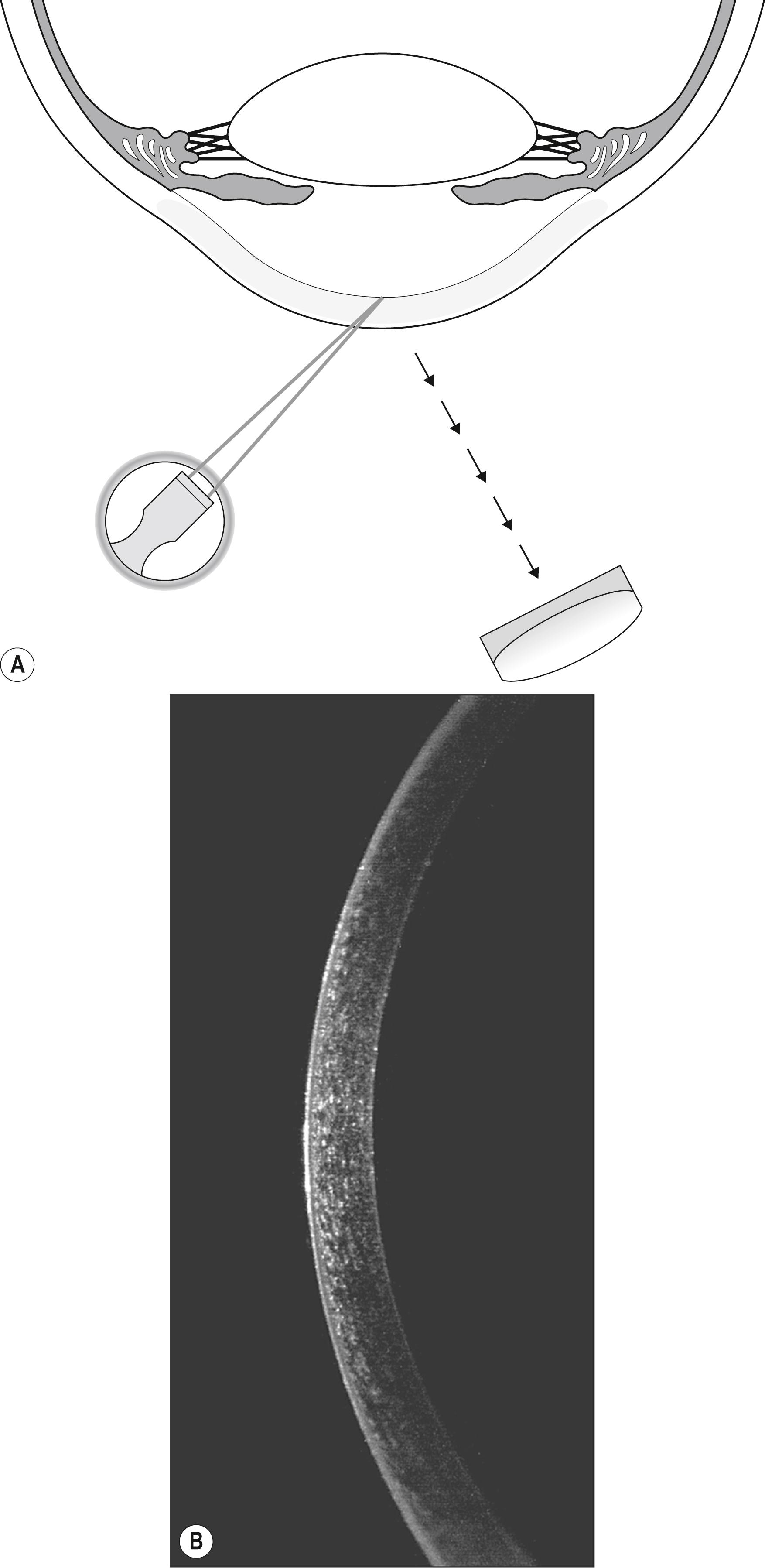 Fig. 7.1, ( A ) Slit illuminator and biomicroscope. ( B ) The magnified optical section is the most important capability of the slit lamp biomicroscope.