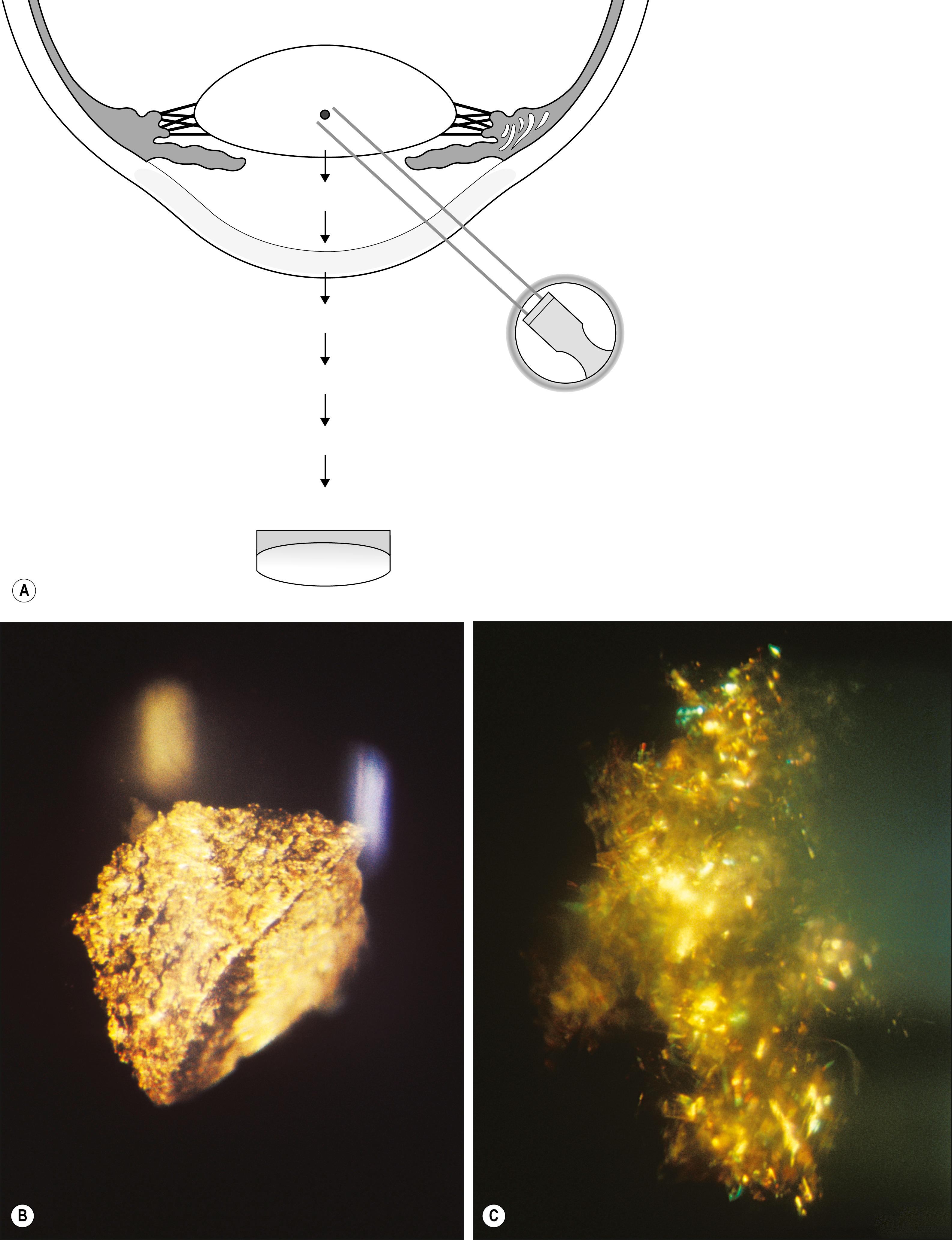 Fig. 7.11, ( A ) and ( B ) Metallic foreign body in a clear lens, isolated with a moderate, tangentially applied beam. ( C ) “Christmas tree” cataract shown in great clarity due to the unilluminated surfaces in front and behind the subject, facilitated by tangential illumination.