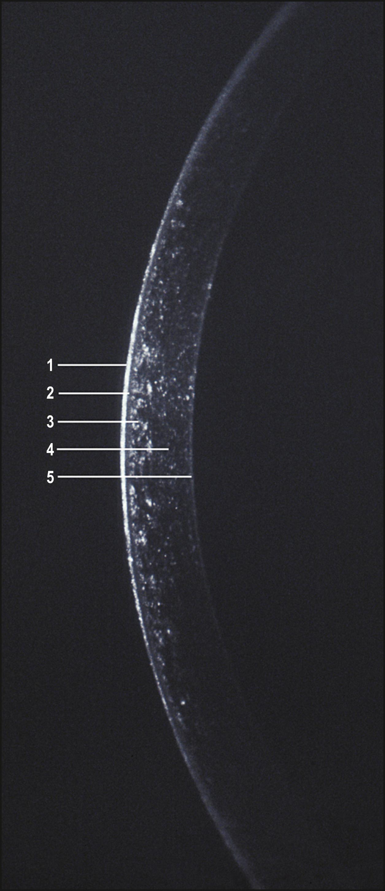 Fig. 7.12, Optical section through a normal cornea demonstrating its principal layers. (1) Tear film, (2) epithelium, (3) anterior stroma with high density of keratocytes, (4) posterior stroma with lower density of keratocytes, (5) posterior layer (Descemet membrane and endothelium).