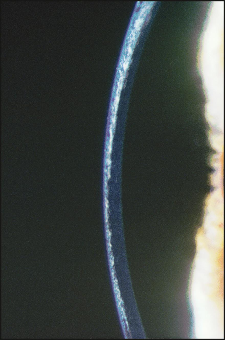 Fig. 7.15, Anterior to midstromal deposits are seen in a patient with dystonia.