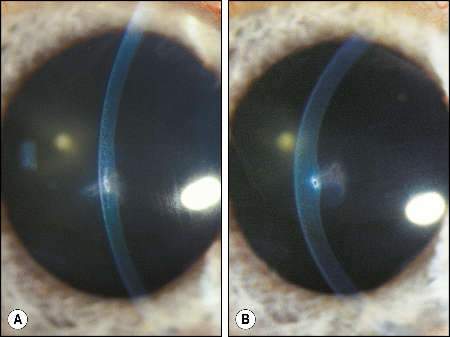 Fig. 7.16, ( A ) and ( B ) Two images demonstrating the right-to-left, anterior-to-posterior track of a penetrating foreign body.