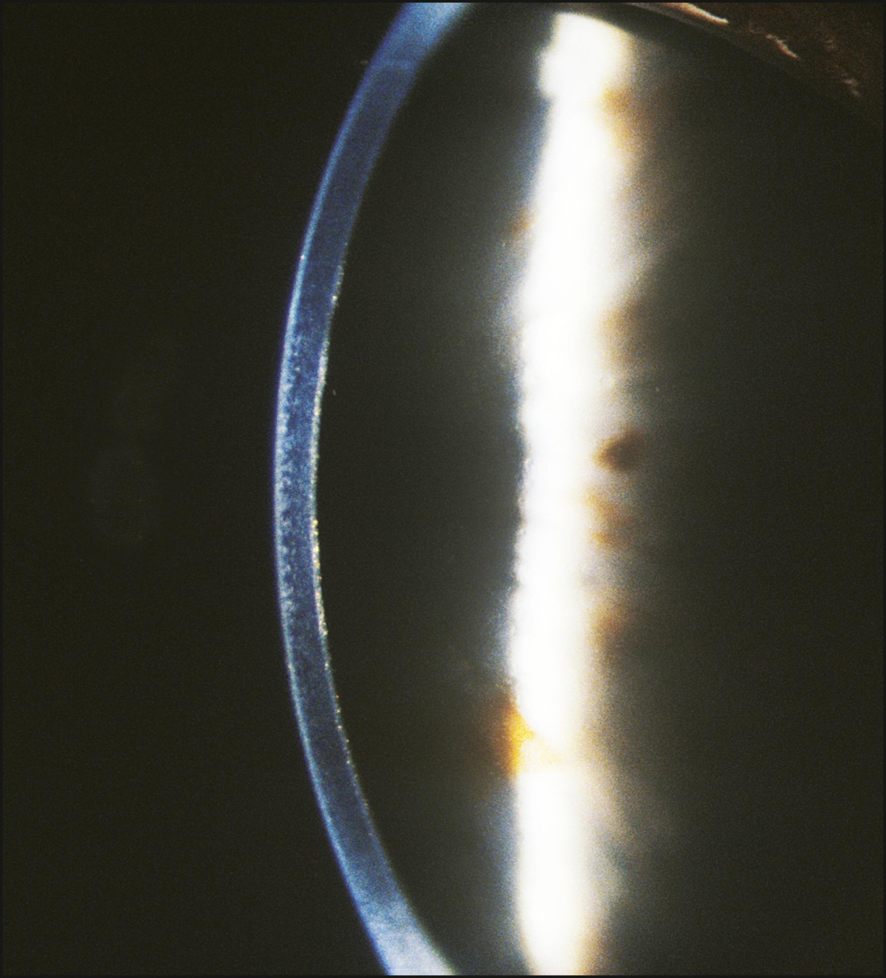 Fig. 7.18, Abnormal amounts of light are seen reflected from the endothelial layer in Fuchs dystrophy.