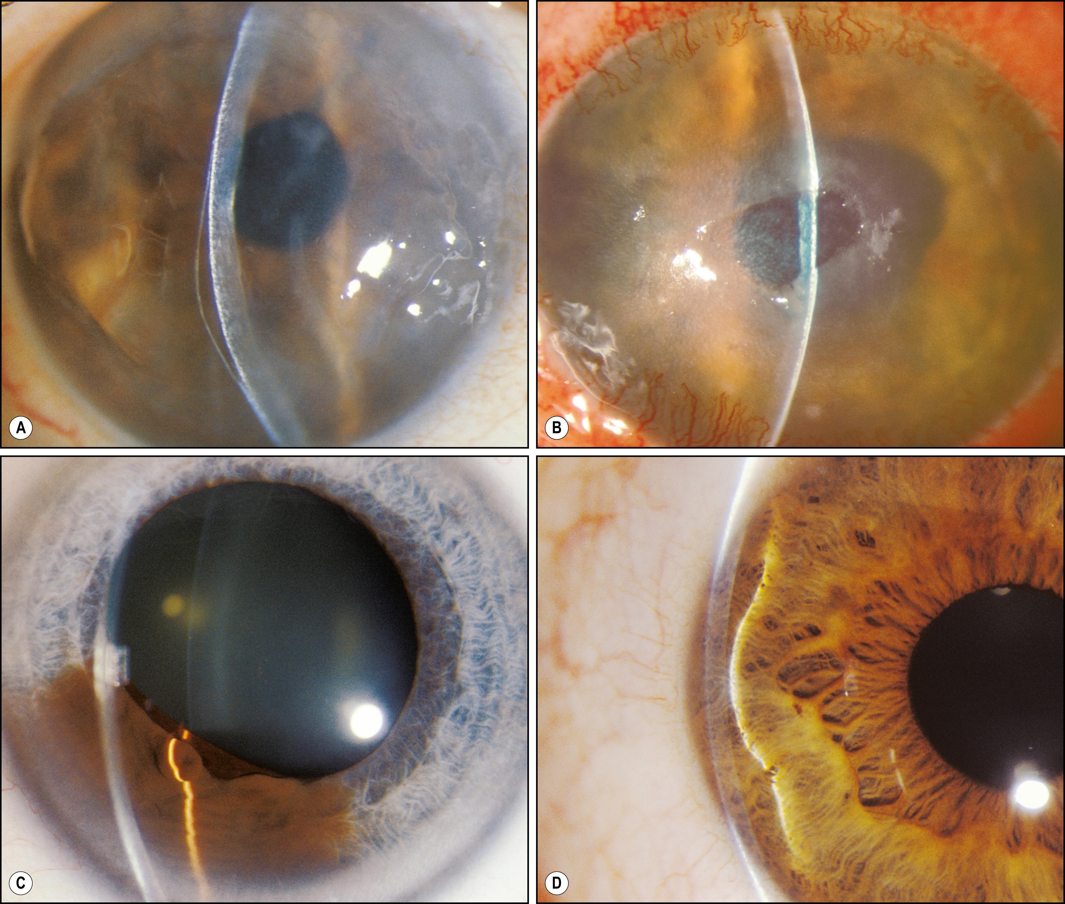 Fig. 7.20, ( A ) Aphakic bullous keratopathy with the large bulla well described by the slit beam. ( B ) Chemical injury with central loss of epithelium and limbal vascularization. ( C ) An iris lesion clearly seen as elevated by the contour of the slit beam. ( D ) The deviating slit beam indicates a focal elevation of the iris by a ciliary body cyst.