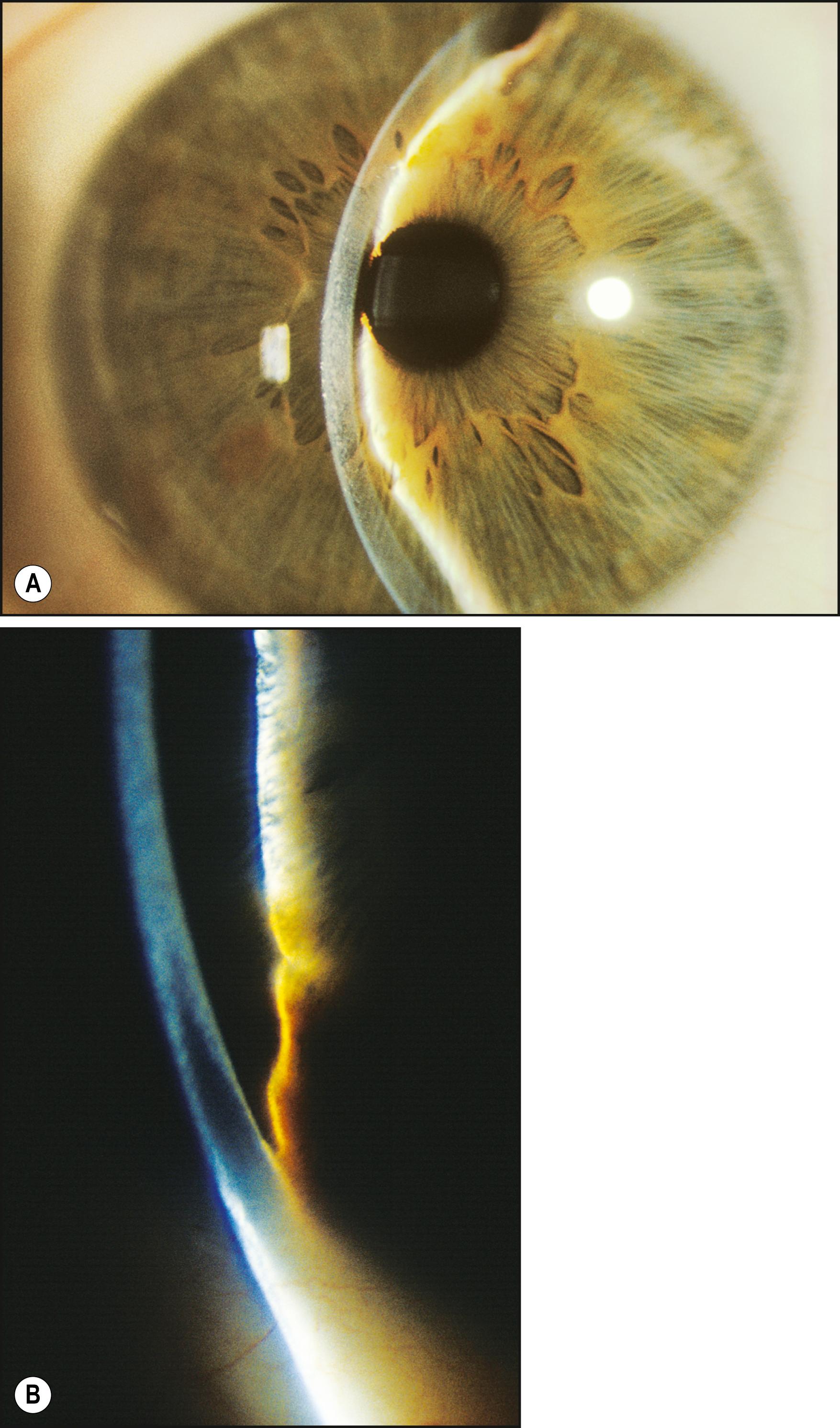 Fig. 7.22, ( A ) A very shallow anterior chamber is evidenced by the proximity of reflections from the iris and the corneal endothelium. Superiorly, contiguous reflections indicate an area of closed angle. ( B ) An area of the angle closed by an iris lesion.