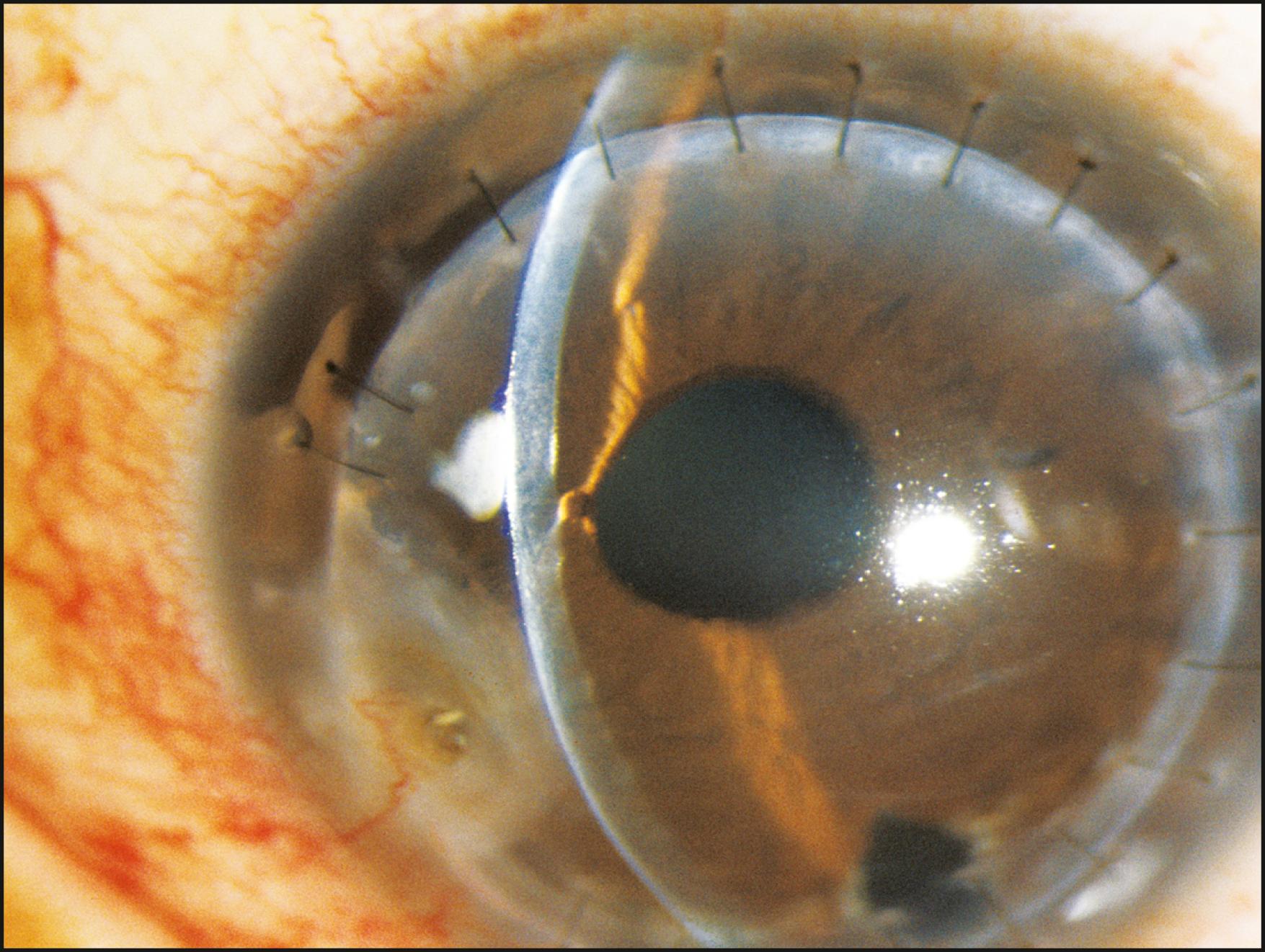 Fig. 7.23, Iris tissue adherent to the posterior corneal surface in an eye that, following successful penetrating corneal transplantation, suffered a penetrating foreign body injury.