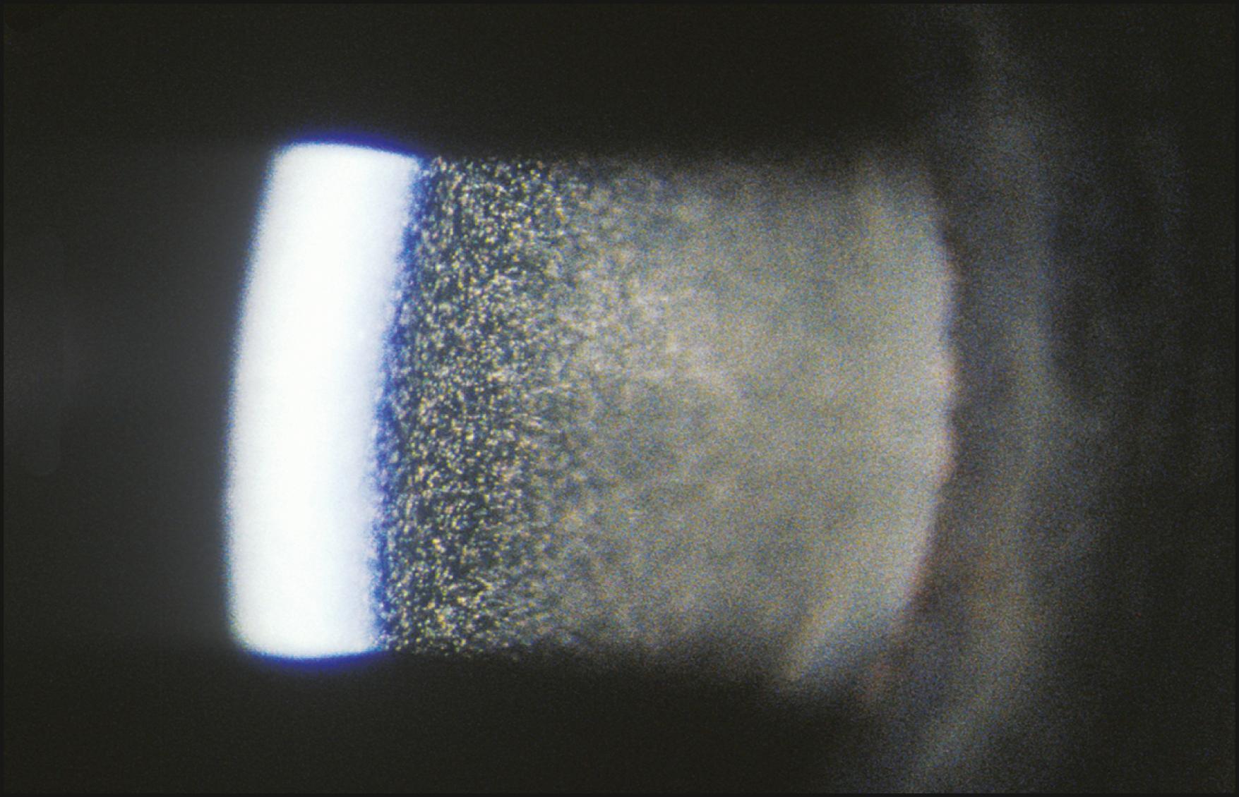 Fig. 7.25, A dramatic expression of four-plus aqueous cells in a case of endophthalmitis.