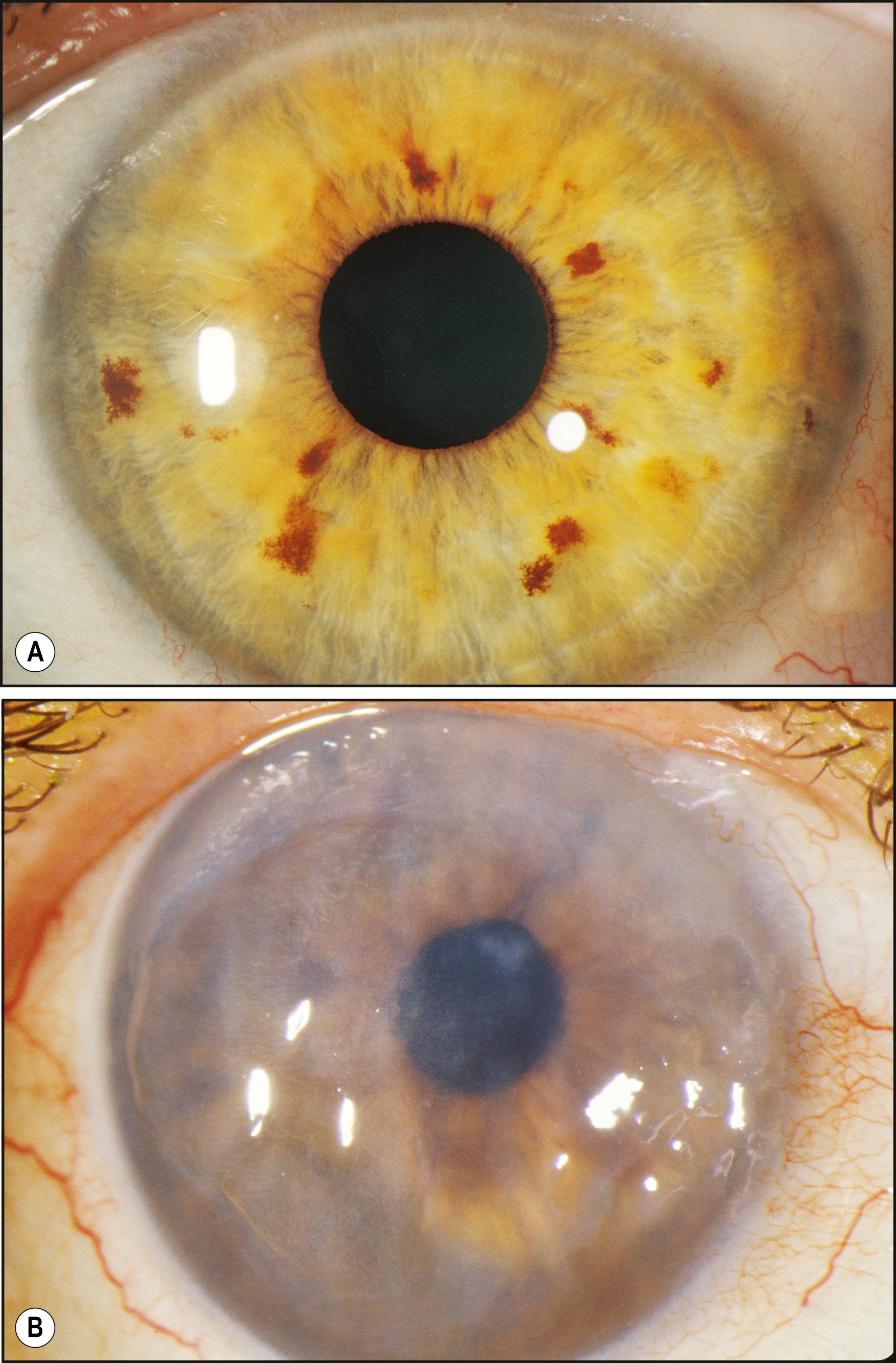 Fig. 7.26, ( A ) Specular reflections faithfully reproduce the shapes of light sources on the surface of a normal tear film layer. ( B ) The specular reflections are altered from normal by the condition of bullous keratopathy.