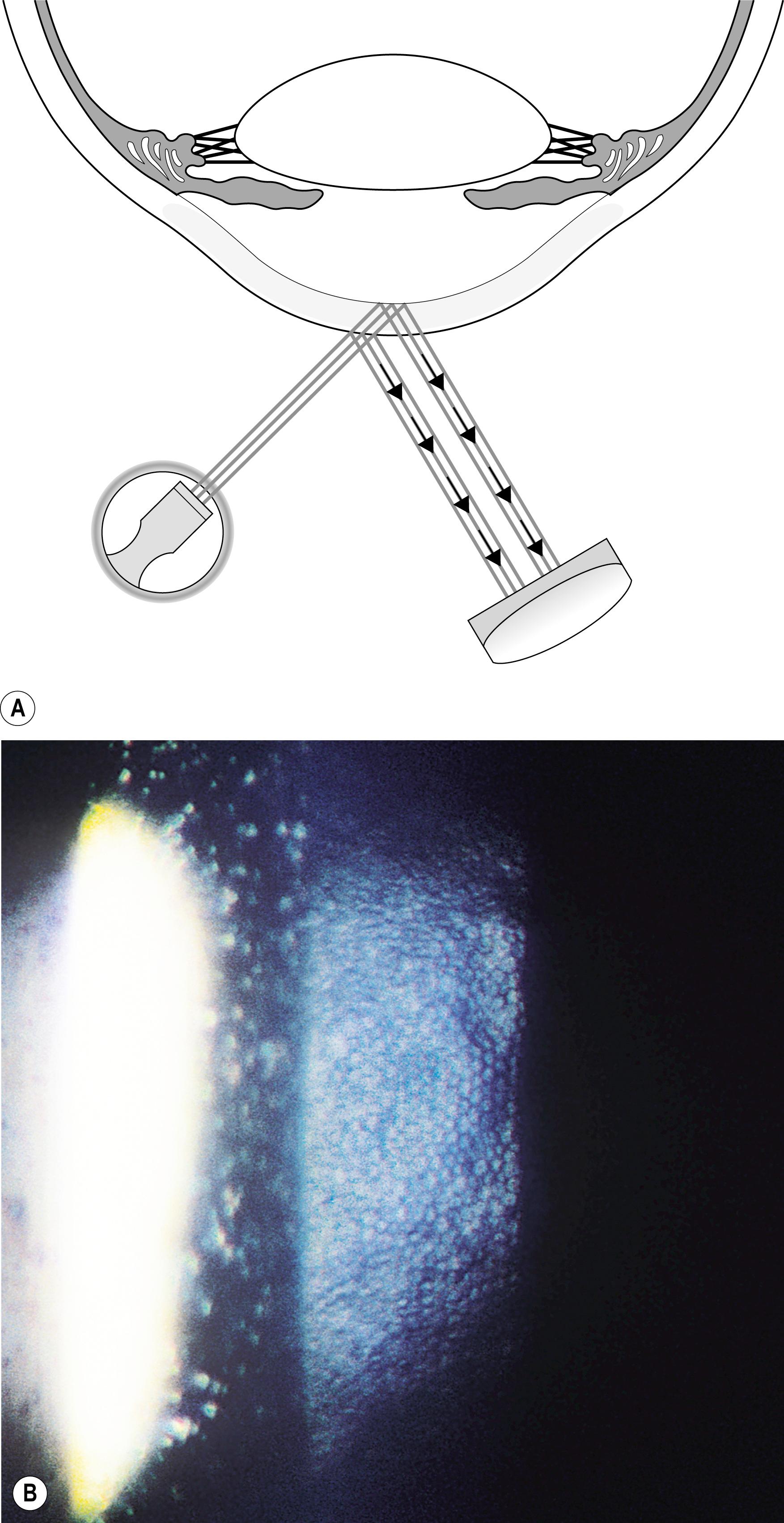 Fig. 7.27, ( A ) The bright specular reflection from the tear film layer is easily seen. The reflection from the endothelium is found just adjacent on the side opposite the light source. ( B ) At 40× magnification, even the small cells of this young, healthy endothelium are appreciable.