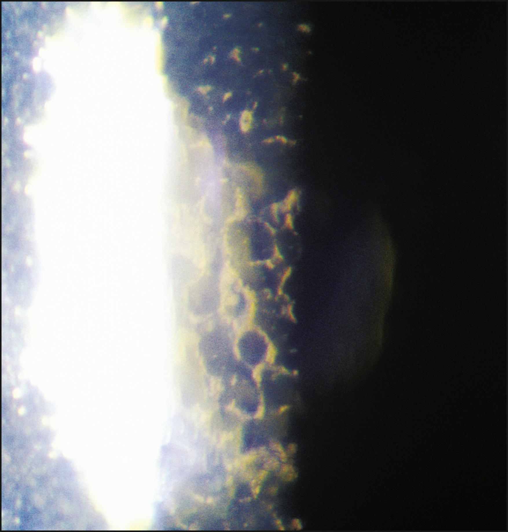 Fig. 7.29, Severe Fuchs dystrophy preventing a view of endothelial cells.