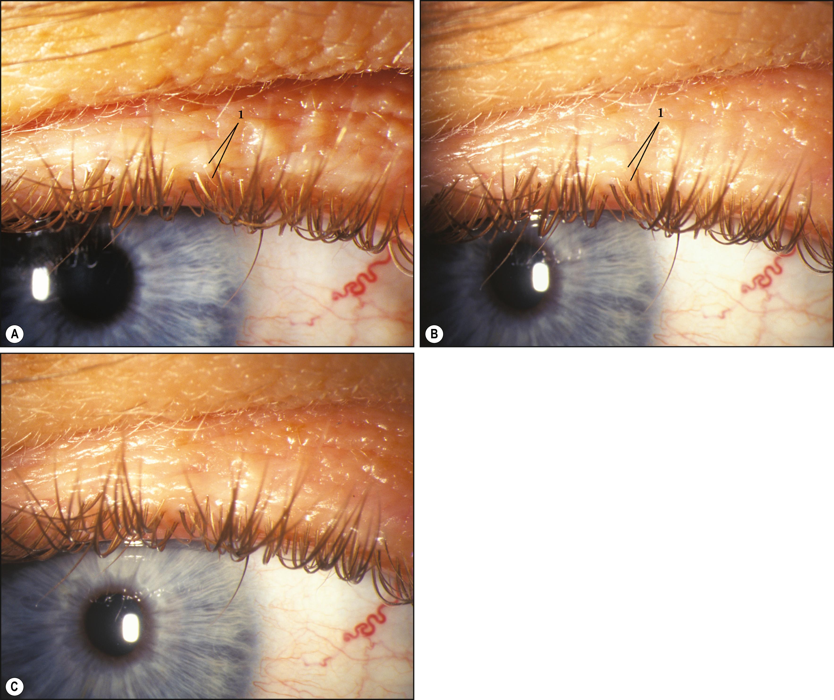 Fig. 7.3, ( A ) Illuminated from the left, the diminutive cilium and the white excrescence at its base (1) are clearly visible. The tangentially applied light diminishes specular reflections and enhances contrast for good visualization of subtle findings. ( B ) Illuminated from the front, specular reflections abound, contrast is minimized, and the essential information is greatly diminished (1) . ( C ) Axial illumination and a slightly altered perspective preclude visualization of the abnormality altogether. Without the views shown in A and B , the examination would be quite incomplete.