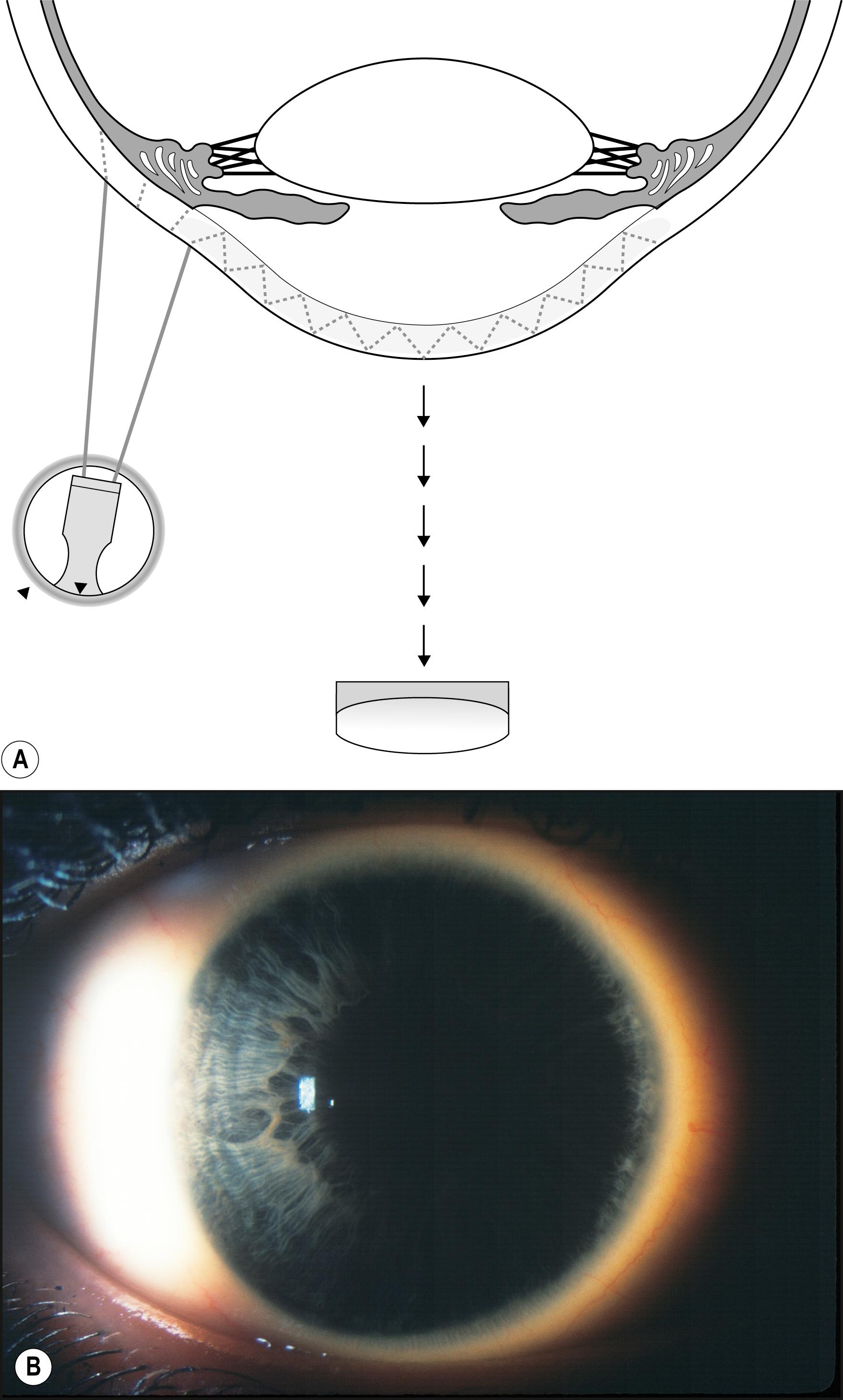 Fig. 7.32, (A) The beam is decentered to facilitate centration of the cornea in the biomicroscope. ( B ) The light at the corneoscleral junction illuminates the cornea by total internal reflection. The normal cornea will not reflect the light along the viewing axis and remains dark against an essentially dark background.